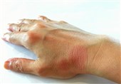 لوپوس را جدی بگیرید؛ حمله بیصدا به قلب، کلیه و پوست